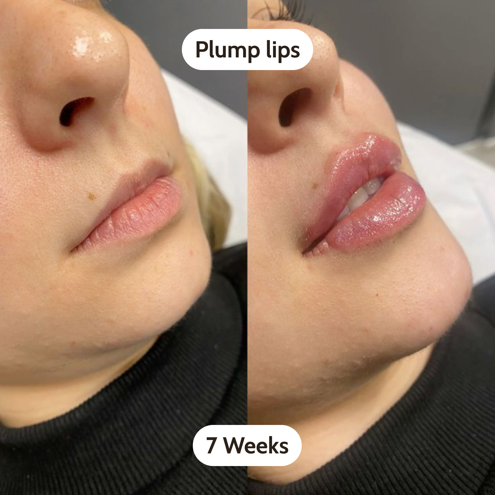 Puraveed - Volure Ampoule